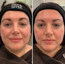 Massageador Lifting Facial